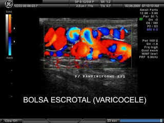 BOLSA ESCROTAL VARICOCELE2