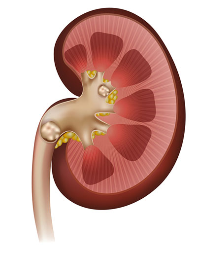 calculo renal