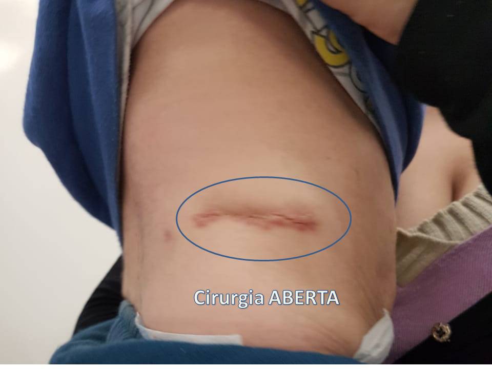 cirurgia aberta