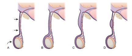 esquema hidrocele