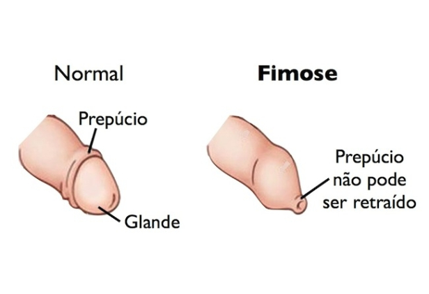 fimose1