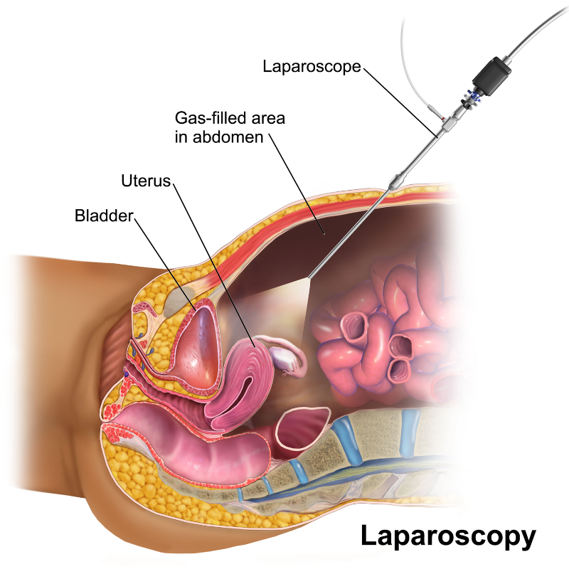 laparoscopia