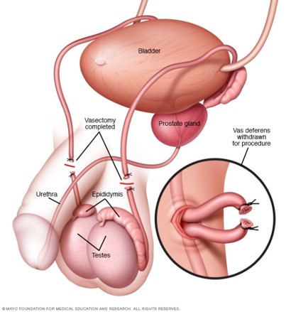 vasectomia